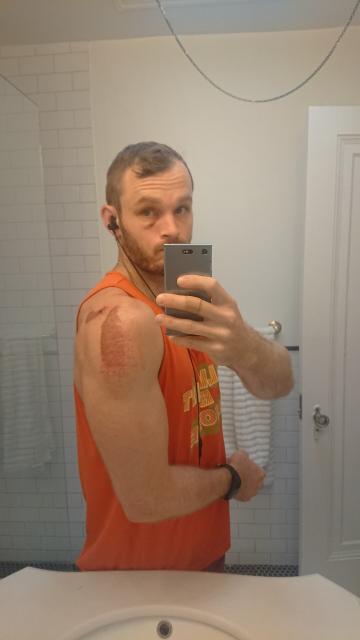 Notthatready taking a selfie in the bathroom mirror. He has a pretty bad black eye and severe road rash on his right shoulder