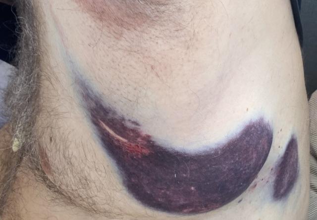 A huge purple bruise over a rib (or two).