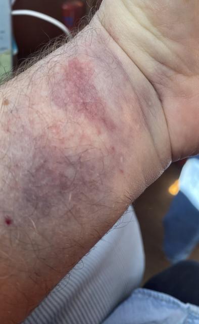 A swollen, badly bruised wrist.