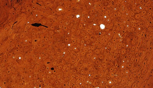 Image is of a part of a thin section of bone (~100-200 microns thick). Overall, the image is orange-brown in colour. There are many faint circle- or bagel-shapes throughout, representing a type of bone structure called an osteon. Inside each osteon is a small hole through which vasculature passes. There are also some larger spaces, which may be circular or oddly shaped, where bone is being actively remodelled - the bone is being eaten away and will later be filled in with new bone.