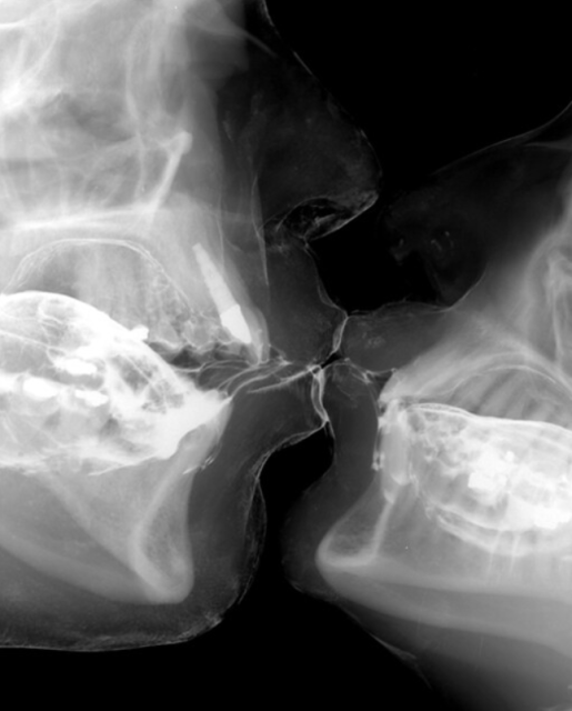 X-ray of two people kissing by artist Wim Delvoye.